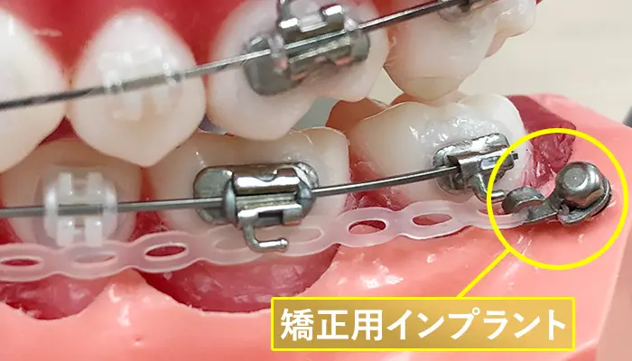 矯正用インプラント（アンカースクリュー）