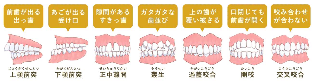 不正歯列