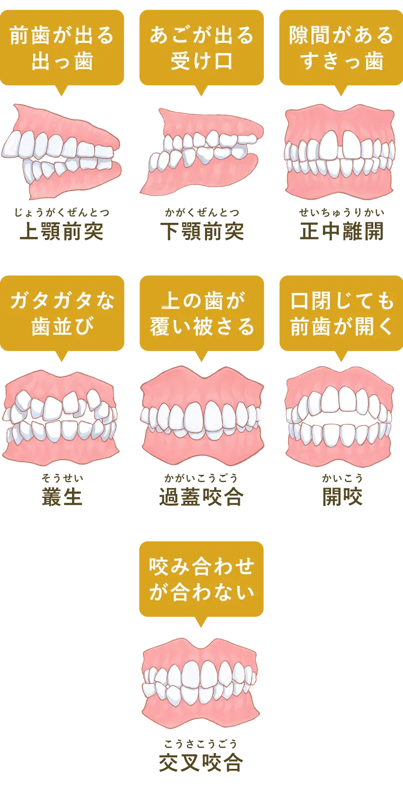 不正歯列